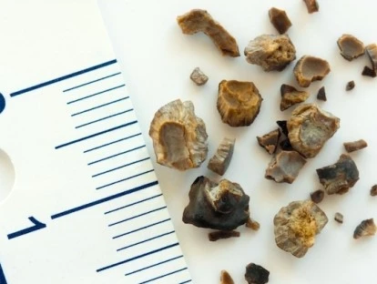 Cirurgia de Cálculo Renal com Plano de Saúde em Carência deve ser coberta integralmente