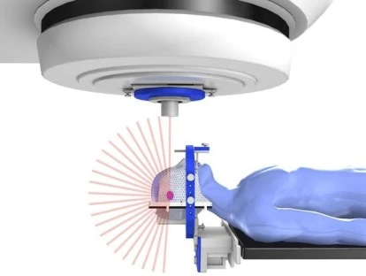 Radioterapia estereotáxica