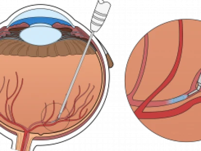 Antiangiogênico Lucentis