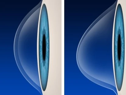 Ceratocone - Crosslinking 