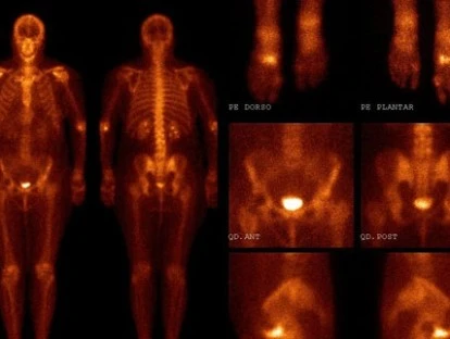 Cintilografia de corpo inteiro com octreotide