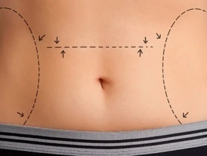 Plano de saúde cobre cirurgia de diástase? Como solicitar 