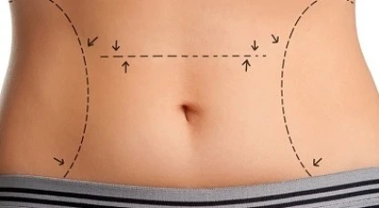 Plano de saúde cobre cirurgia de diástase? Quando a cobertura é obrigatória