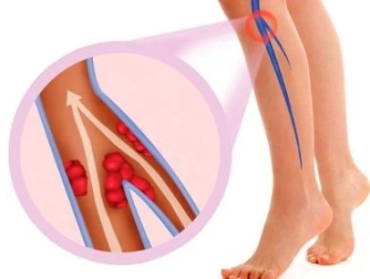Xarelto: planos de saúde e SUS devem custear? Confira!