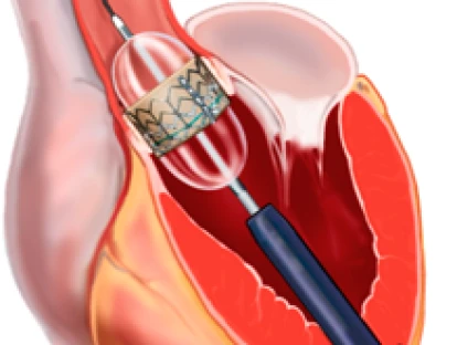Implante percutâneo de válvula aórtica por cateter - TAVI