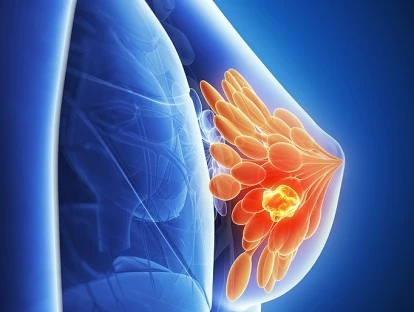 Palbociclibe (Ibrance): saiba se esse medicamento deve ser fornecido pelo plano de saúde! 