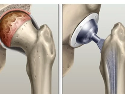 Artroplastia total de quadril: plano de saúde deve cobrir a cirurgia e a prótese de quadril? Entenda!