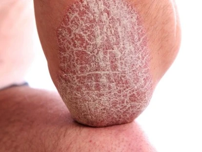 Ustequinumabe - Stelara