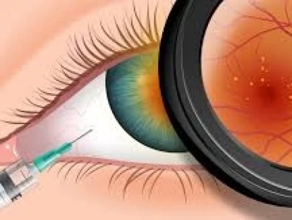 Avastin (bevacizumabe)