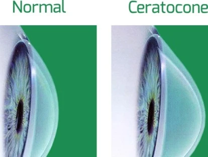 Crosslink - Ceratocone