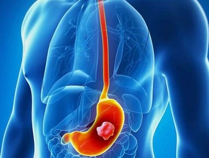 Cyramza (ramucirumabe): plano de saúde deve custear? Veja!