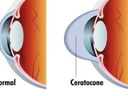 Ceratocone - Tratamento terapêutico de Cross Link