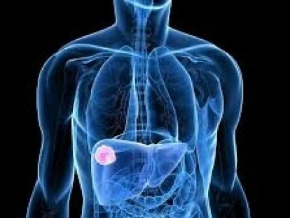 Quimioembolização pelo plano de saúde, entenda!