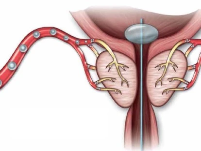 Embolização das artérias da próstata