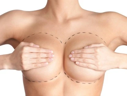 Mamoplastia pós bariátrica e retirada de pele