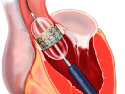 Cirurgia Transapical Cardiáca (TAVI) pelo plano de saúde