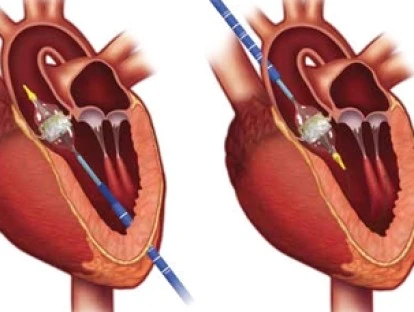 Cirurgia para implante transcatéter da prótese aórtica accurate (TAVI) 