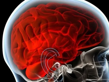 Angiografia cerebral 3D: plano de saúde deve custear exame