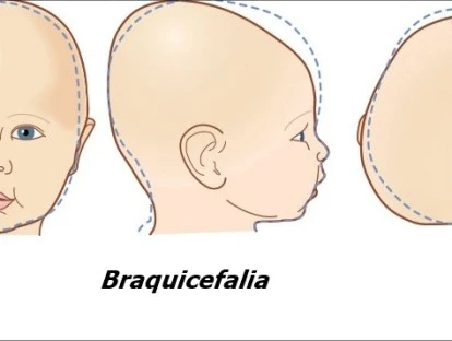 Braquicefalia