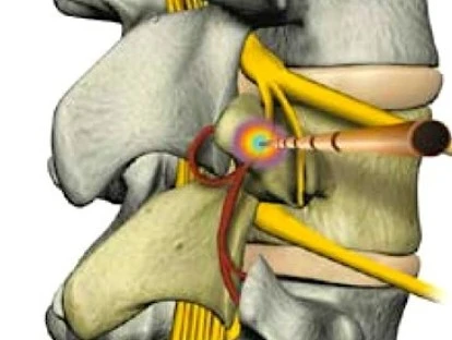 Rizotomia percutânea 
