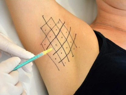 Tratamento de hiper-hidrose axilar com botox deve ser pago pelo plano de saúde