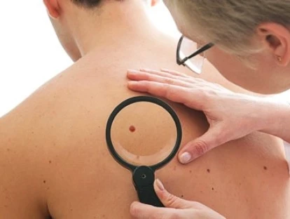 Medicamento Cobimetinibe (Cotellic)