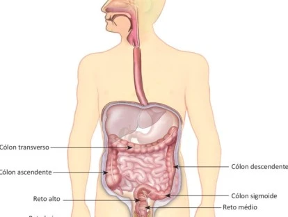  Radioembolização para câncer colorretal metastático