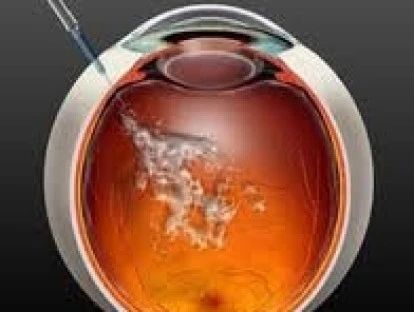 Degeneração Macular Relacionada à Idade