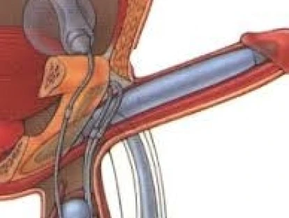 Prótese peniana inflável