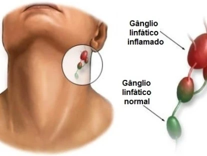 Mabthera - Rituximabe 