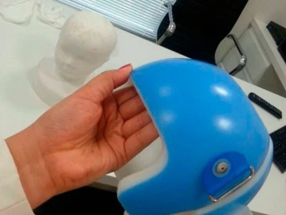 Planos de saúde possuem obrigação contratual em custear capacete para plagiocefalia e braquicefalia. 