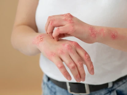 Plano de saúde cobre Skyrizi (risanquizumabe)?