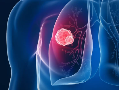 Ablação tumoral: planos de saúde devem custear tratamento