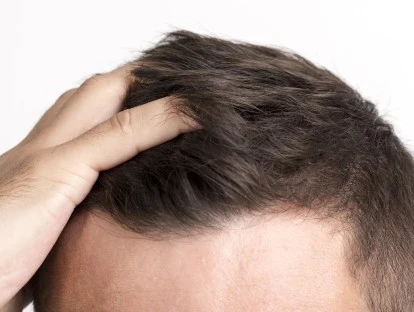 Erro em transplante capilar: Advogada especialista em erro médico fala sobre o assunto!