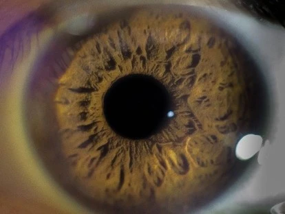 Plano de saúde deve custear Lucentis (ranibizumabe)? Descubra!