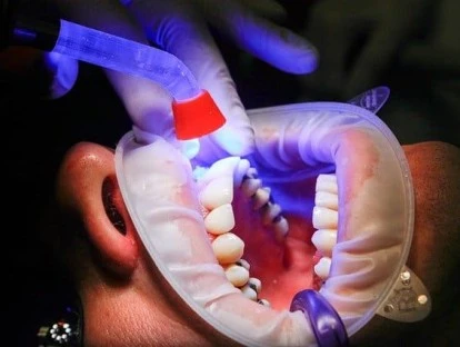Como proceder em caso de erro odontológico em clareamento dental?