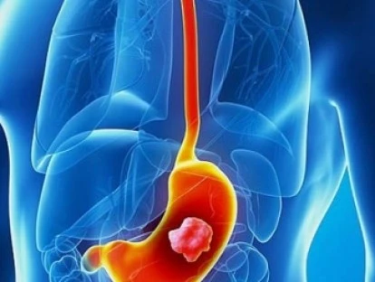 Pembrolizumabe para câncer gástrico: plano de saúde deve tratar câncer de estômago