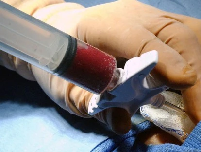 Plano de saúde é obrigado a cobrir o transplante de medula óssea haploidêntico