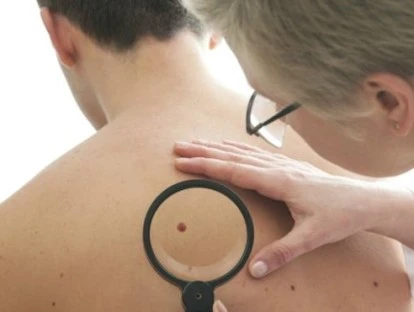 Plano de saúde deve fornecer medicamento Ipilimumabe para tratar câncer