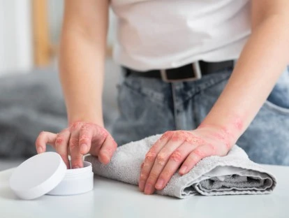 Pacientes com dermatite atópica grave podem usar o FGTS para o tratamento