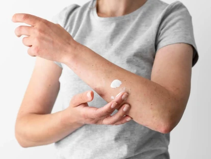 Strata XRT: plano de saúde cobre medicamento para radiodermatite?