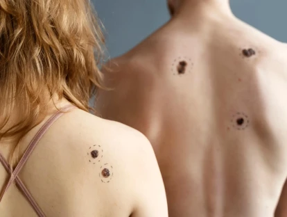 Nivolumabe e relatlimabe pelo plano de saúde: como obter tratamento para o melanoma