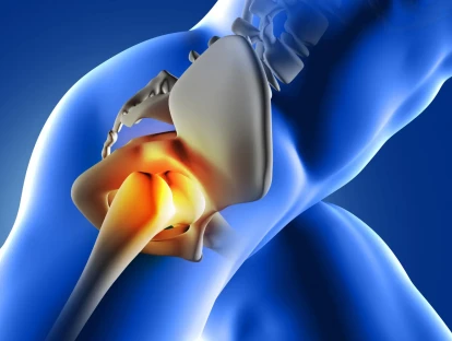Artroplastia de resurfacing pelo plano de saúde: como funciona a cirurgia e o que fazer se o plano recusar