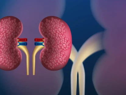 Empaveli (pegcetacoplana): plano de saúde cobre o medicamento?