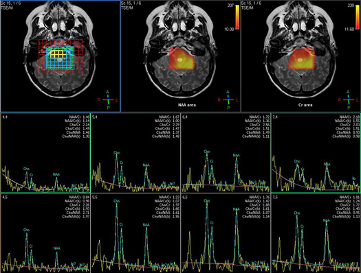 espectroscopia por ressonancia magnetica