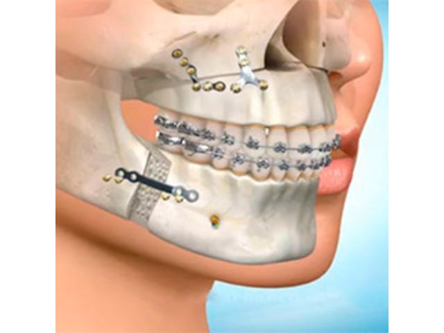 Plano de saúde é obrigado a realizar cirurgia de buco-maxilo-facial e custear material
