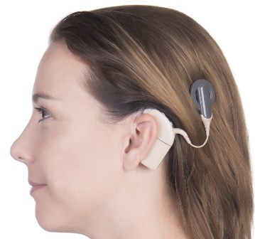 Implante coclear - Plano de saude deve fornecer aparelho mais moderno