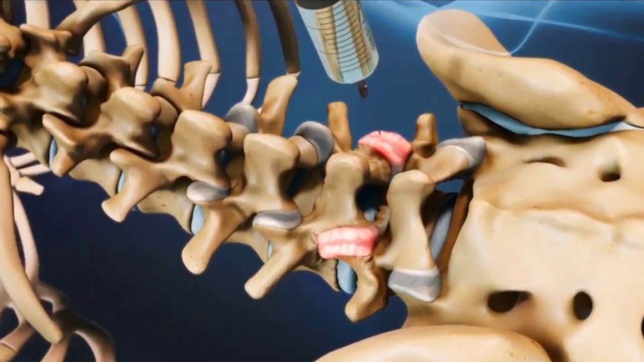 Cirurgia de Rizotomia por Radiofrequ&ecirc;ncia deve ser custeada pelo plano de sa&uacute;de