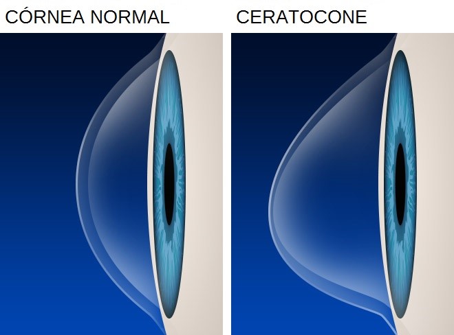 Ceratocone - Plano de saúde deve custear tratamento