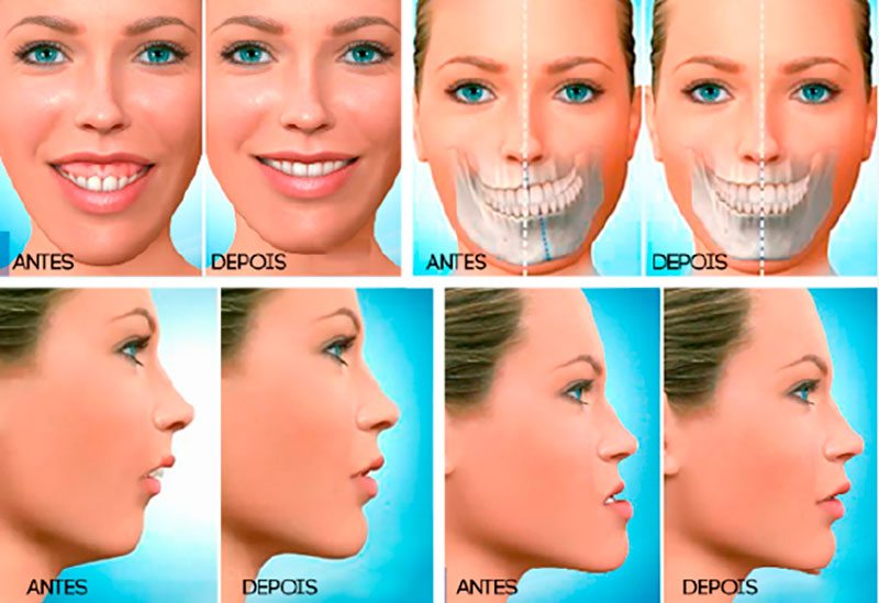 Cirurgia buco-maxilo-facial e materiais cirúrgicos - Plano de saúde é condenado a custear